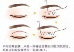 北京埋線雙眼皮修復(fù)價格盤點