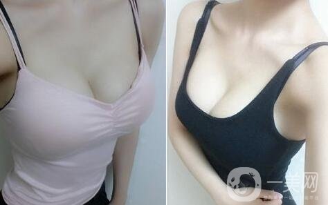 假體隆胸術(shù)有哪些特點？