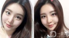 注射隆鼻手術(shù)價格是多少？