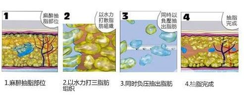 負(fù)壓吸脂*果和水動(dòng)力一樣嗎?哪個(gè)更好?
