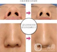 鼻翼縮小手術(shù)恢復(fù)過程詳解