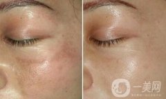 彩光祛斑一次*果嗎?