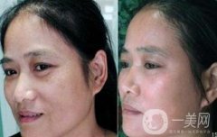 彩光祛斑后幾天結(jié)痂?怎么保養(yǎng)才能恢復(fù)得更好?