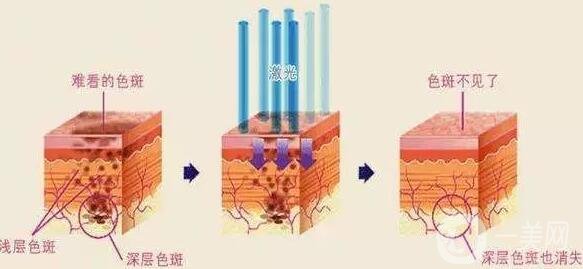 激光祛痘注意事項(xiàng)有哪些？