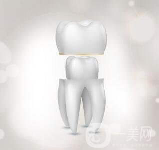 烤瓷牙的種類和優(yōu)缺點分別是什么呢？