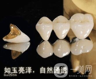 烤瓷牙的種類和優(yōu)缺點分別是什么呢？