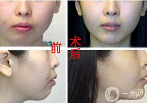 玻尿酸墊下巴