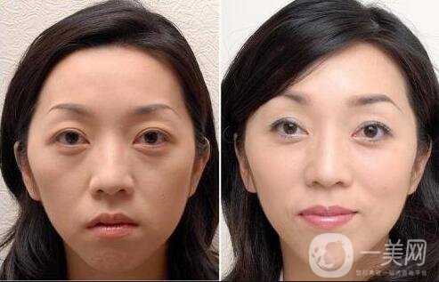 玻尿酸墊下巴