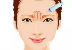 眉間紋打了玻尿酸多久才能恢復?