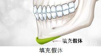 硅膠墊下巴要疼幾天？如何緩解這種疼痛感？