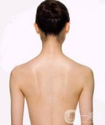 后背吸脂1000毫升多嗎？有明X的瘦背果嗎？