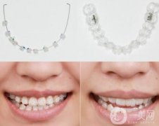 3m半隱形牙套價格多少錢?貴嗎?