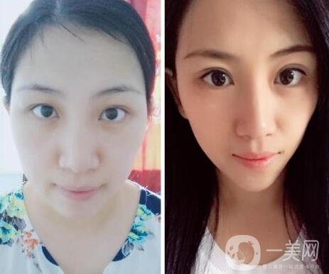 阿爾法美眼術(shù)過(guò)程是怎么做的?