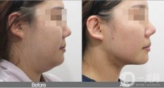 雙下巴吸脂不戴頭套有什么后果？