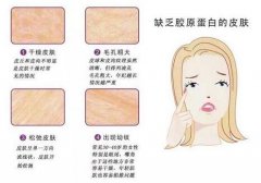 填充膠原蛋白發(fā)硬凸起應該怎么辦？