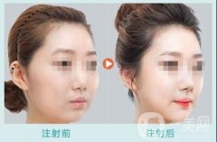 玻尿酸豐太陽要幾支才夠？