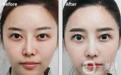 鼻整形修復(fù)手術(shù)的風(fēng)險和并發(fā)癥怎么控制?