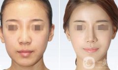 鼻翼縮小術(shù)費(fèi)用大概是多少？