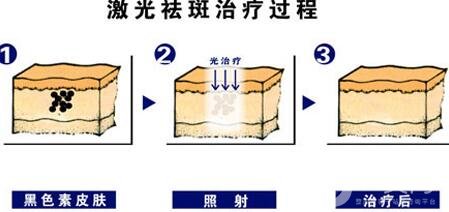 激光祛斑的優(yōu)勢有哪些?為什么這么多人去做?