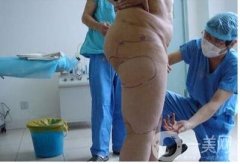 大腿抽脂多久恢復(fù)正常?恢復(fù)階段變化解說