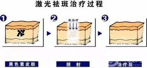 激光去雀斑會(huì)反彈嗎?術(shù)后注意事項(xiàng)有哪些?