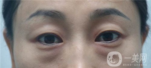 激光去眼袋的價(jià)格多少？要打幾次？