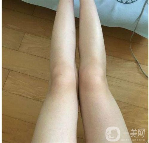激光溶脂瘦大腿疼嗎？可以忍受嗎？