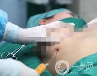 自體脂肪豐胸