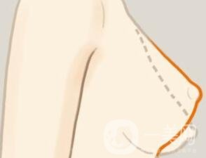 乳房下垂矯正后會反彈再次下垂嗎？術后穿什么內衣？