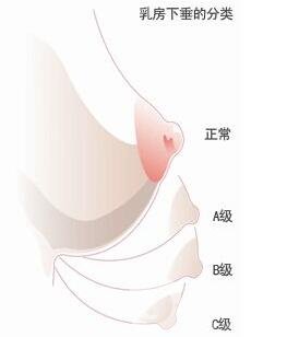 乳房下垂矯正后會反彈再次下垂嗎？術后穿什么內衣？