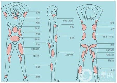 全身吸脂減肥危害大嗎？會不會死人？