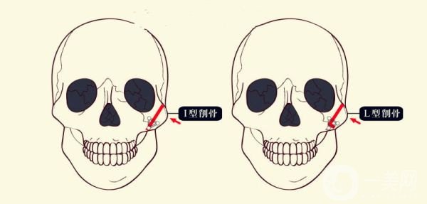 顴骨內(nèi)推和磨骨之間的區(qū)別是什么？哪個*果好些？