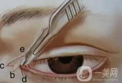 開眼角疤痕增生怎么辦?怎樣才能除掉?