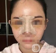 隆鼻固定膠帶幾天去掉？術(shù)后6天去掉會(huì)不會(huì)太早？