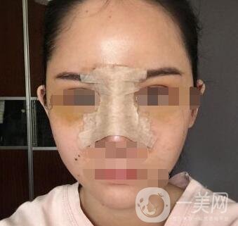 隆鼻固定膠帶幾天去掉？術(shù)后6天去掉會(huì)不會(huì)太早？