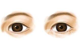開眼角要多少錢？單獨(dú)開眼角價(jià)格貴不貴？