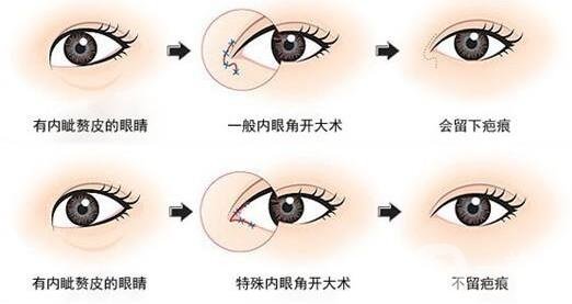 開眼角前后照片圖，放大眼睛不是一點(diǎn)點(diǎn)