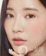 開(kāi)眼角前后照片圖，放大眼睛不是一點(diǎn)點(diǎn)