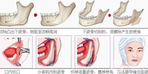 寬下頜角整形手術(shù)原來是這樣做的!【解析】