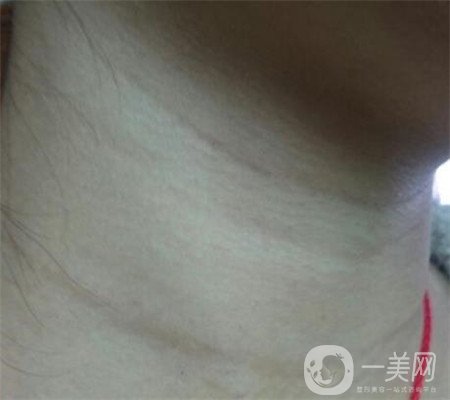 頸部除皺多少錢？會(huì)不會(huì)很貴？