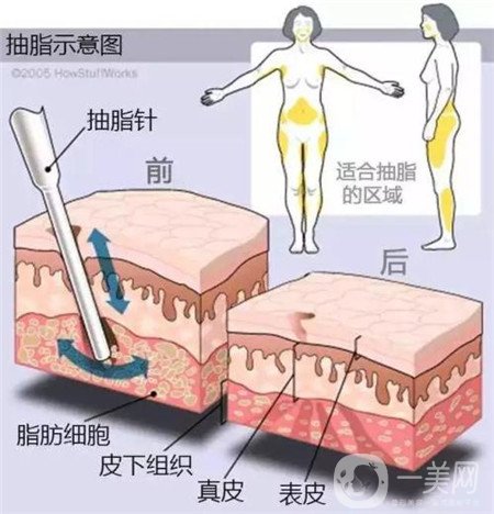 局部吸脂痛苦嗎?多久可以恢復(fù)呢?