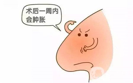 隆鼻手術(shù)恢復(fù)要多久才能自然？這期間要注意什么？