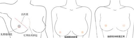 隆胸失敗之后應該怎么處理？怎樣修復？