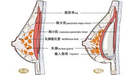 曼托假體和麥格假體哪種手感更好？教你怎么選擇？