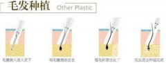 毛發(fā)種植費(fèi)用大概要多少錢？