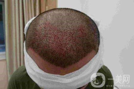 毛發(fā)種植費(fèi)用大概要多少錢(qián)？