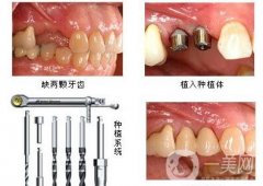 湖州種植牙多少錢(qián)一顆?大概收費(fèi)情況說(shuō)明