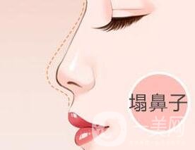 自體軟骨隆鼻費用貴嗎?要多少錢?