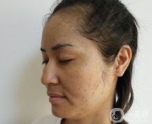 激光祛斑祛痘的后遺癥，你知道嗎？