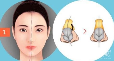 歪鼻矯正注意事項